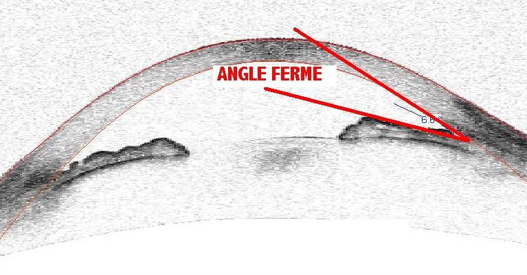 angle fermé