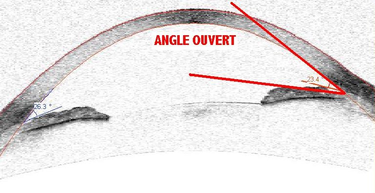 angle ouvert