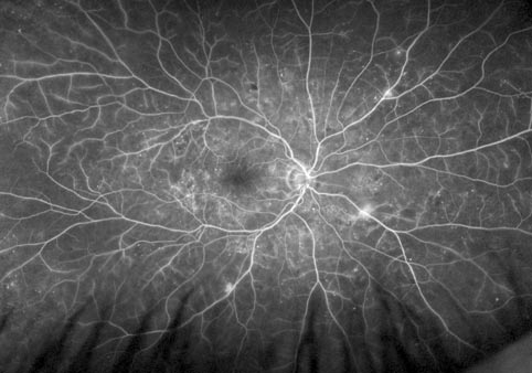 rétinopathie diabète oeil