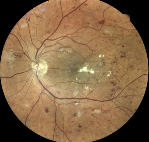 rétinopathie